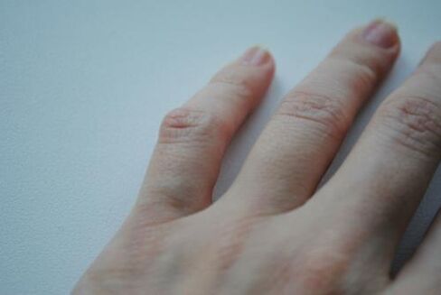 Väikesele sõrmele tekkis liigesepõletik. 