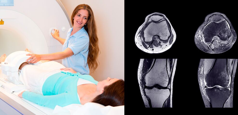 põlveliigese diagnoosimine