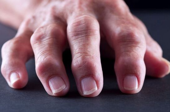 Artroosist või artriidist tingitud sõrmede liigeste deformatsioonid